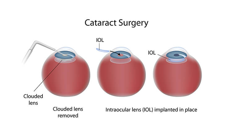 cataract eye surgery in delhi