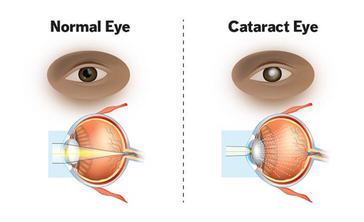 Cataract Eye Surgery