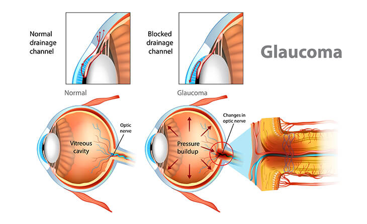 Glaucoma Surgery