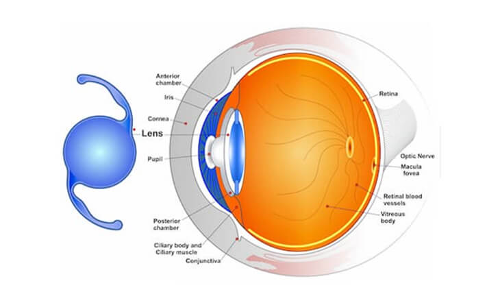 types of intraocular lens