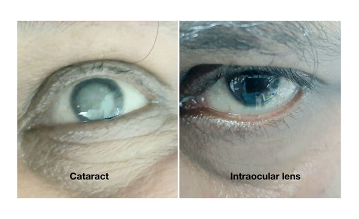 types of intraocular lens