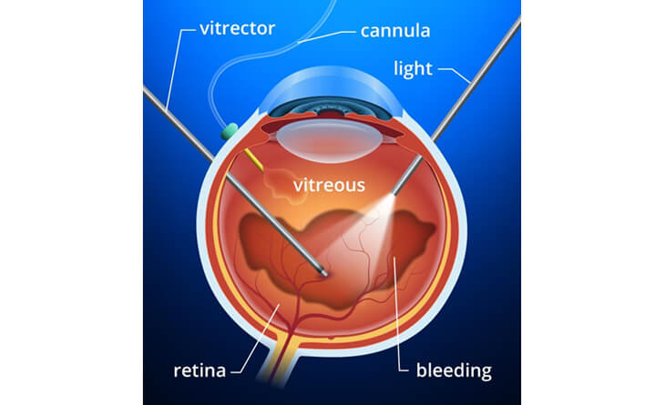 Retina and Vitreous