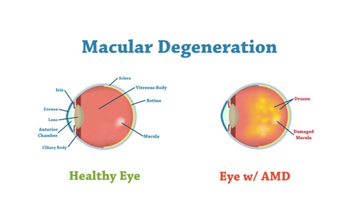 Retina or Vitreous - Dr Anisha Gupta -48