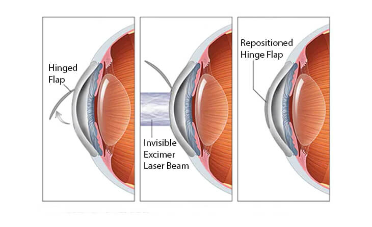 Lasik Surgery in Delhi