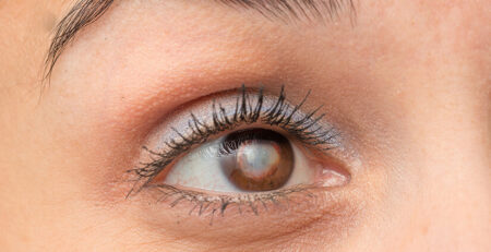 cataract surgery in delhi