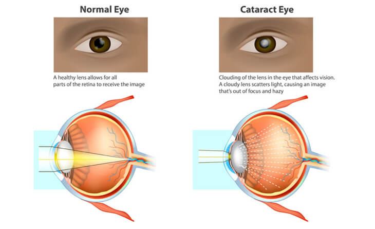 Cataract Eye Surgery in delhi