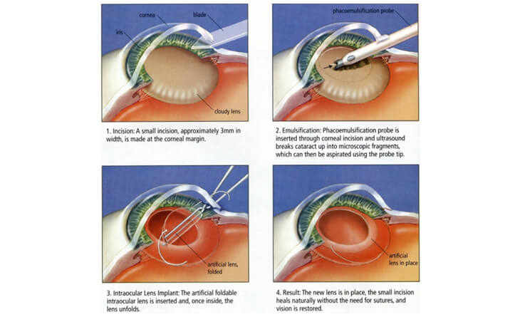 Cataract Eye Surgery