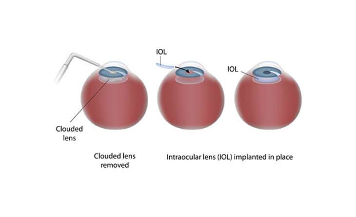 Intraocular lens implant for vision correction