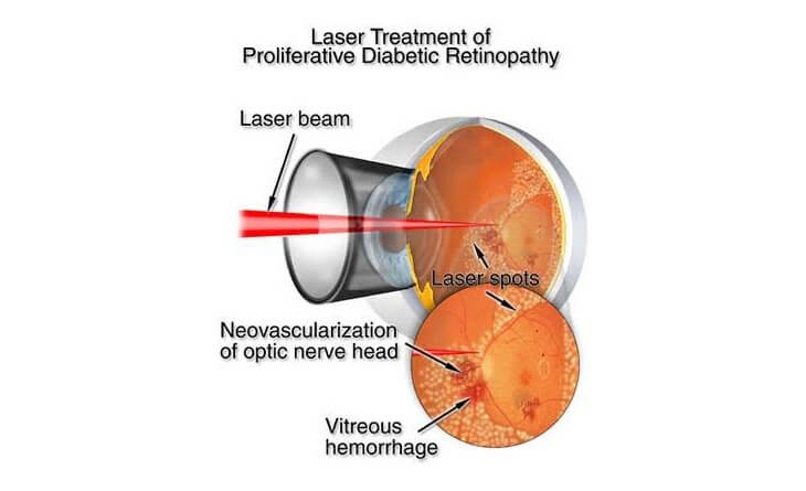 diabetic retinopathy treatment