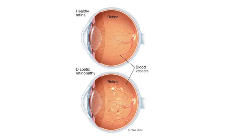 diabetic retinopathy treatment