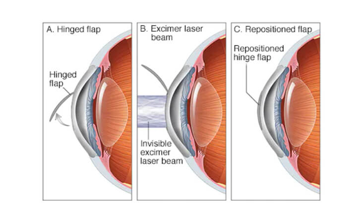 Lasik Surgery in Delhi