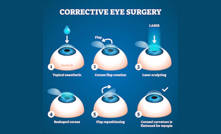 Lasik Surgery in Delhi