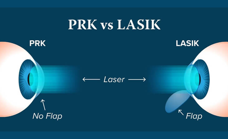 Lasik Surgery in Delhi