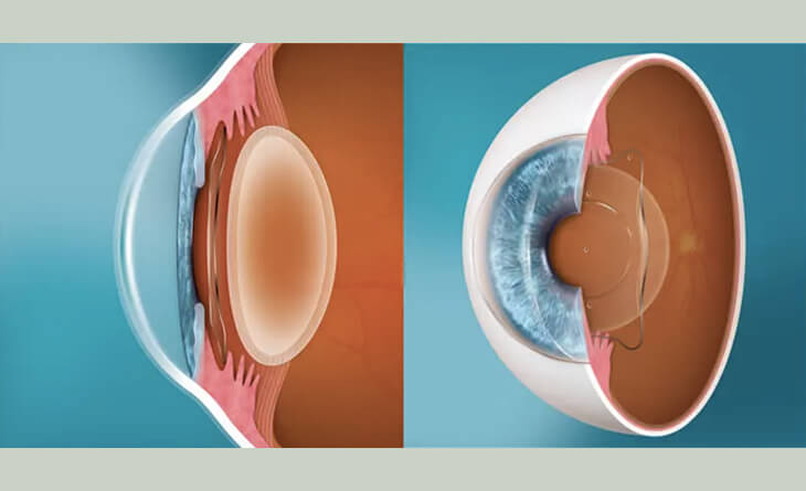 Lasik Surgery in Delhi