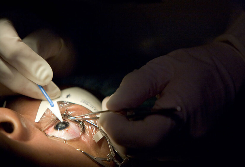 Lasik Surgery in Delhi