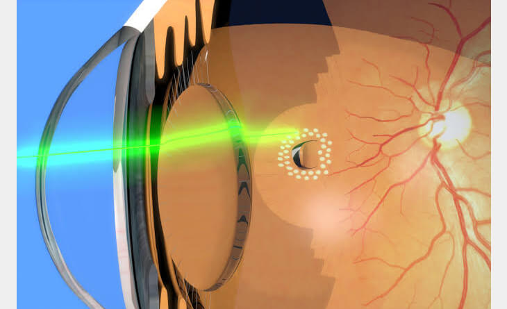 retinal detachment surgery