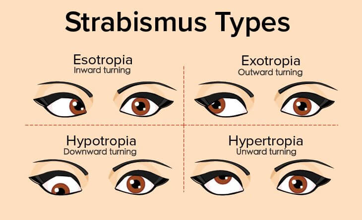 squint eye surgery