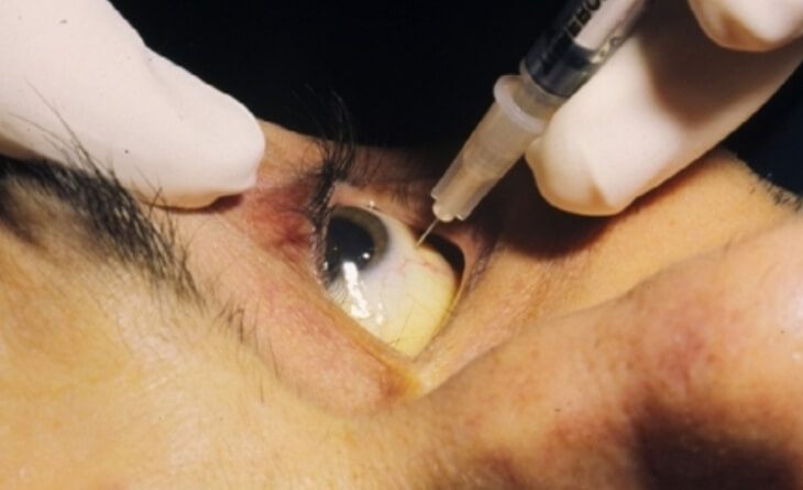 Diabetic retinopathy treatment