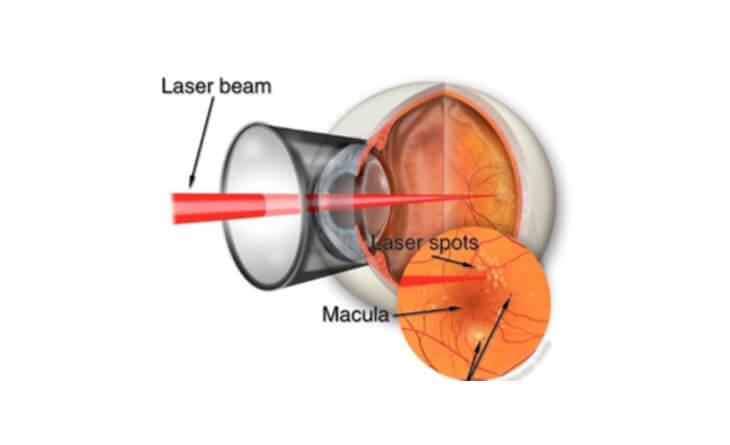 Diabetic retinopathy treatment