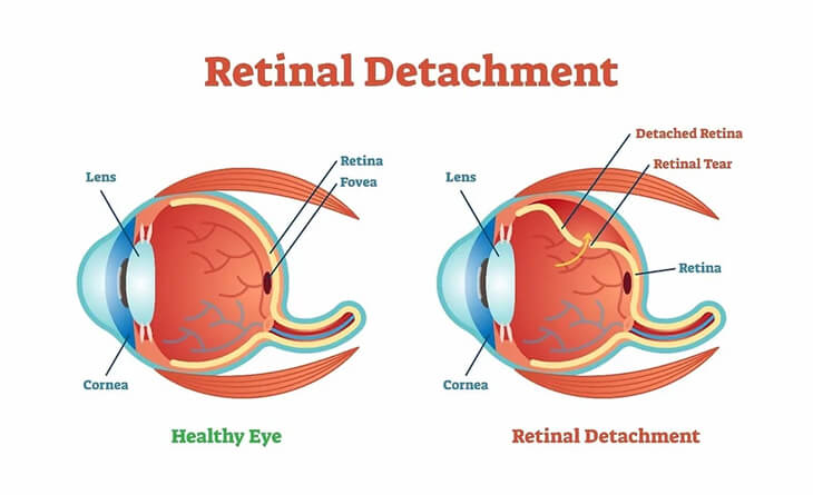 retinal detachment surgery