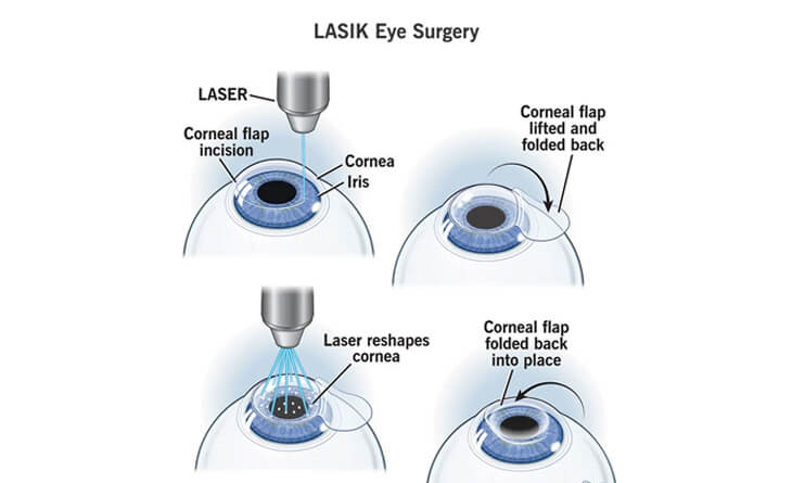 Lasik Surgery