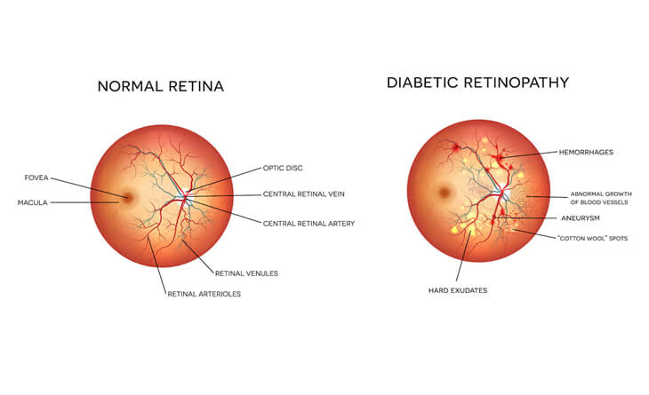 Diabetic retinopathy treatment