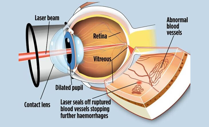 diabetic retinopathy