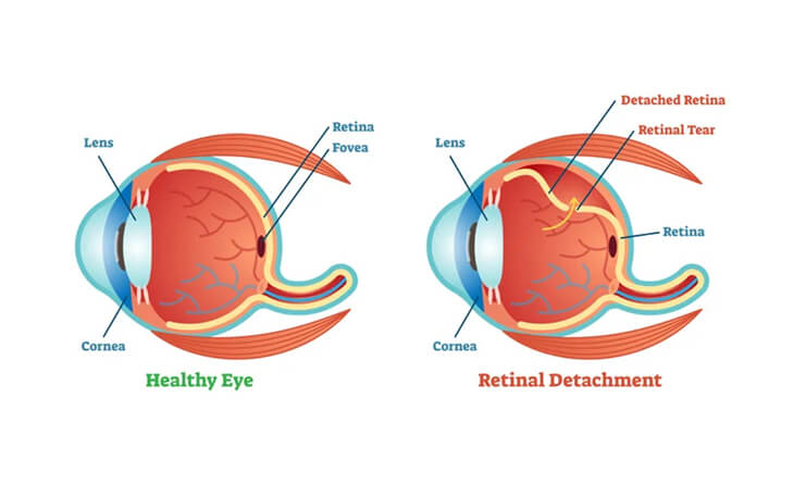 retinal detachment surgery