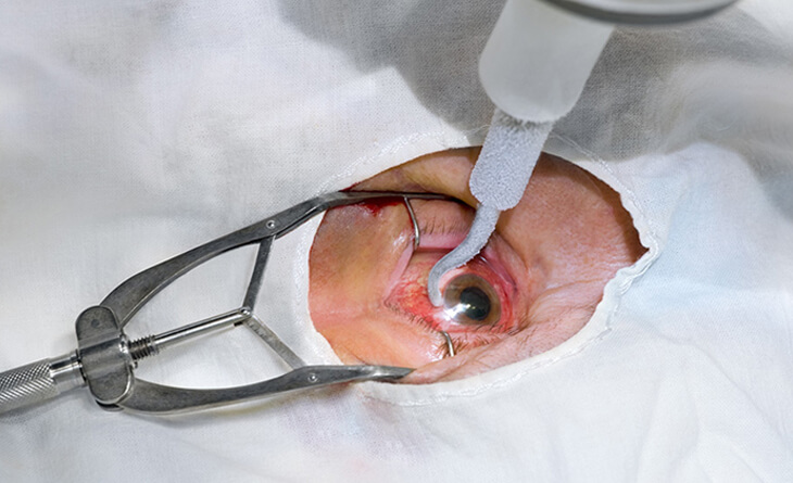 retinal detachment surgery