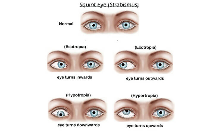 squint eye surgery