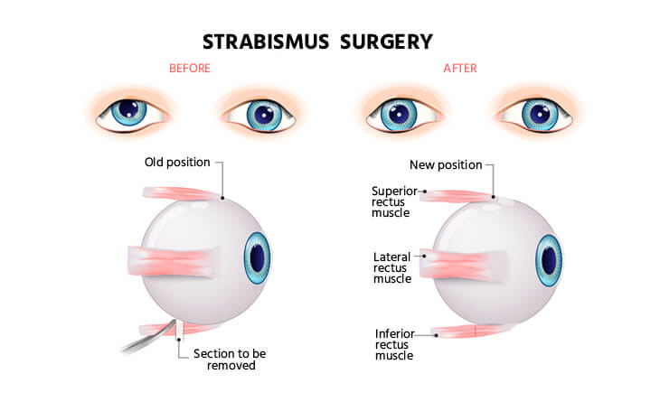 squint eye surgery