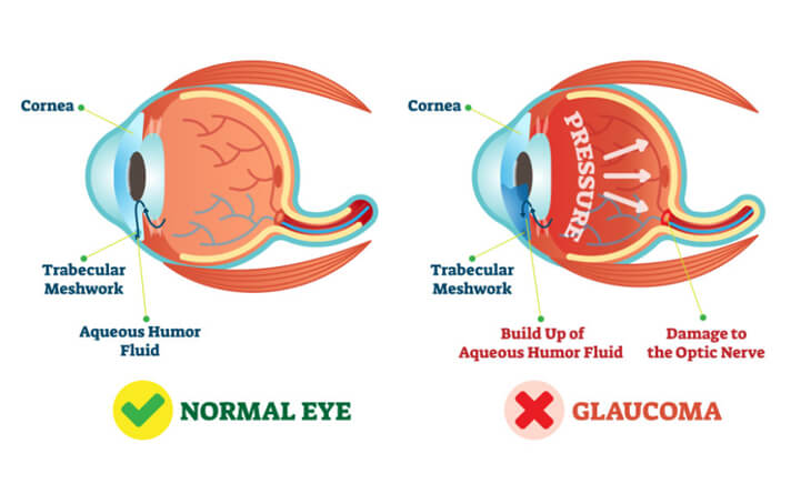 Glaucoma Treatment