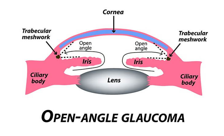 Glaucoma Treatment