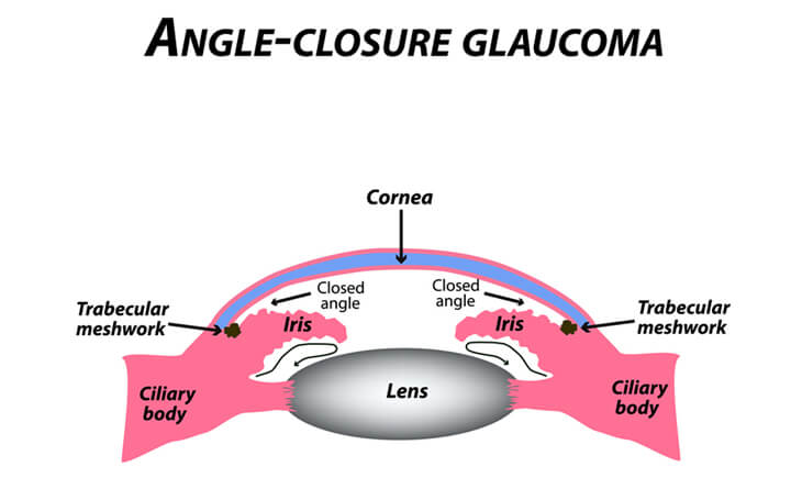 Glaucoma Treatment