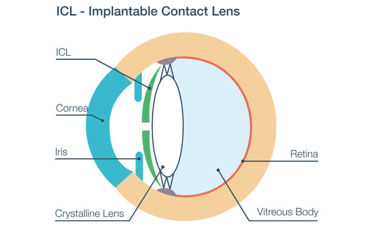 Implantable Collamer Lens