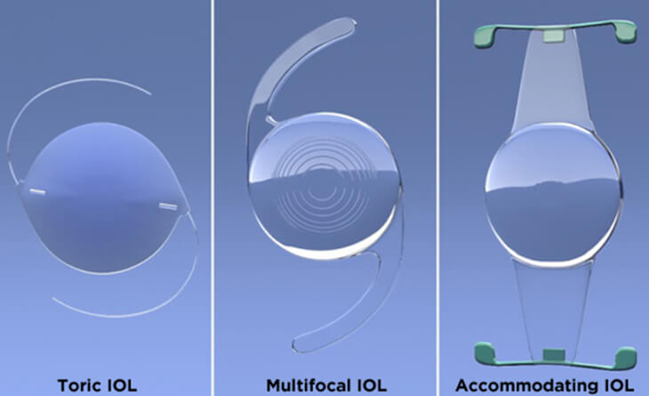 Cataract Surgery