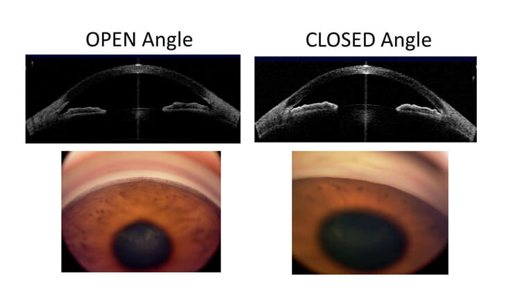 Glaucoma Treatment