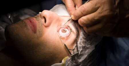 Lasik Surgery