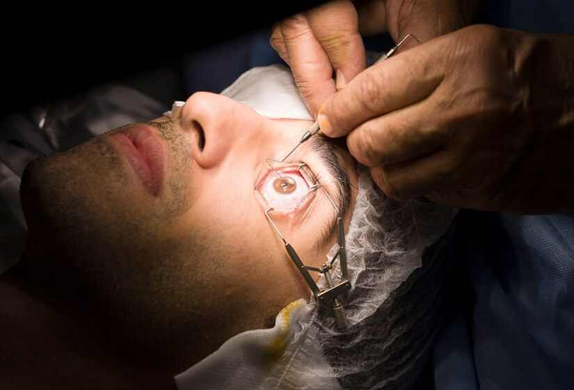 Lasik Surgery