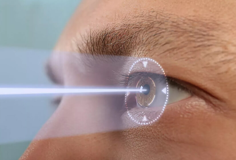 Lasik Surgery