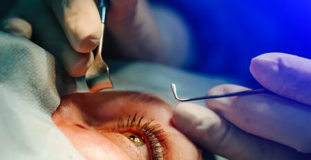 Cataract Surgery