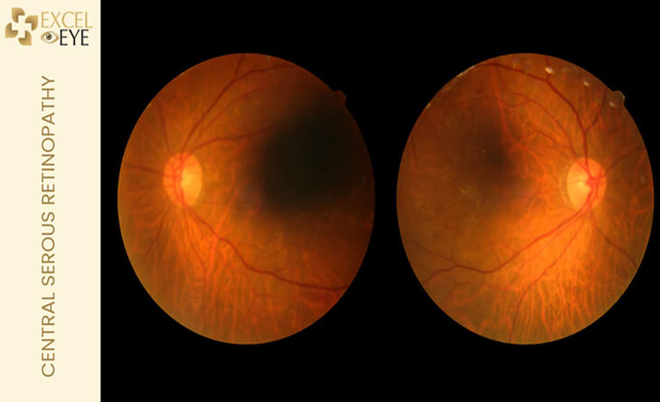 What is Blurred Vision in Pregnancy - Dr Anisha Gupta - Eye Specialist in Delhi -03 Blurry Vision in Pregnancy