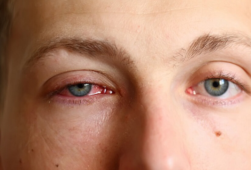Pink Eyes