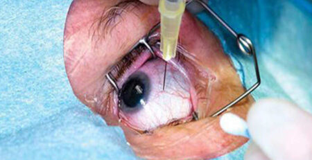 retinal haemorrhage treatment