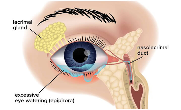What Causes Watery Eyes in the Elderly - Dr Anisha Gupta - Eye Specialist in Delhi -02 Watery Eye Causes