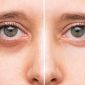 PRP eye treatment