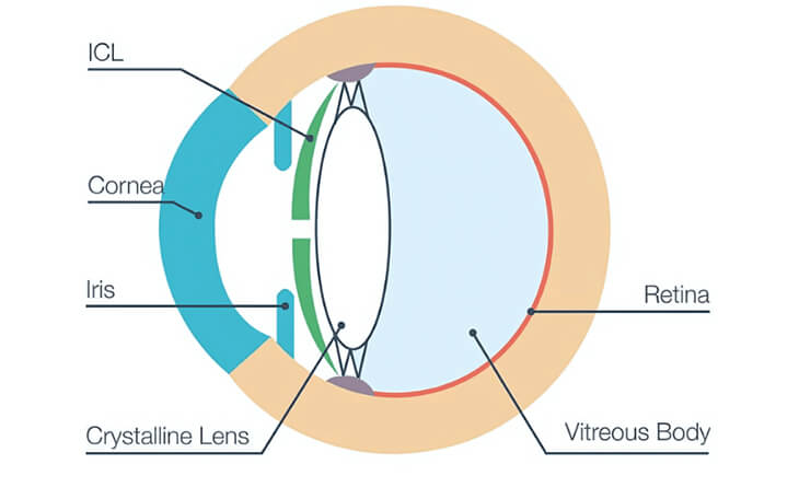 Implantable Contact Lens