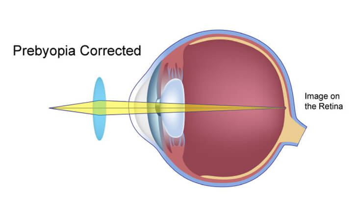 Advanced Laser Vision Correction for Presbyopia Treatment - Dr Anisha Gupta - Eye Specialist in Delhi -02 lasik surgery