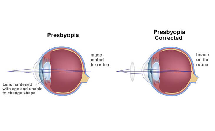 Advanced Laser Vision Correction for Presbyopia Treatment - Dr Anisha Gupta - Eye Specialist in Delhi -03 lasik surgery