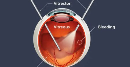 retina surgery
